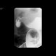 Carcinoma of the lienal flexure: RF - Fluoroscopy